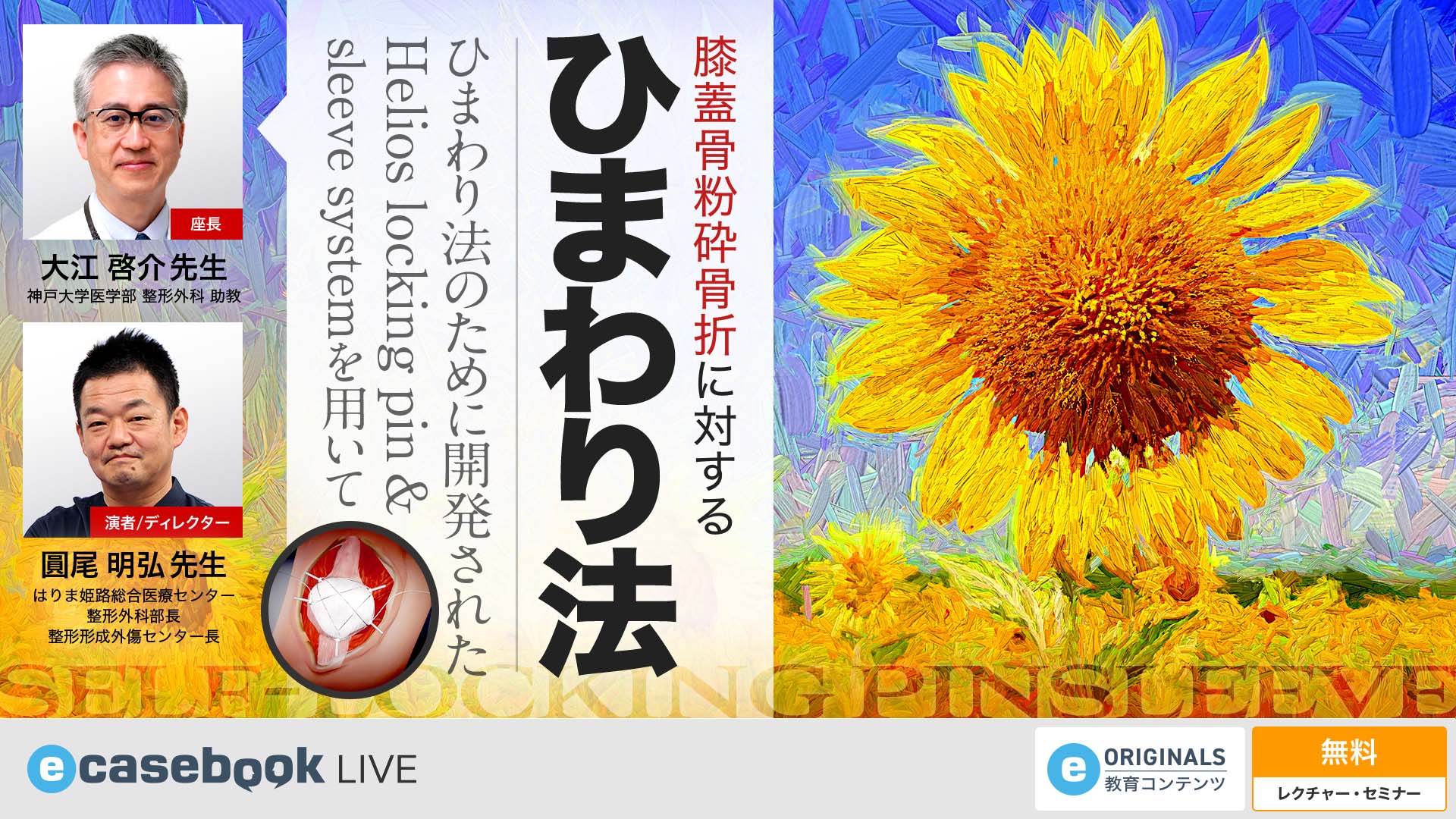 愛称板　ひまわり VIDEO: 膝蓋骨粉砕骨折に対するひまわり法 | 整形外科 | e-casebook LIVE