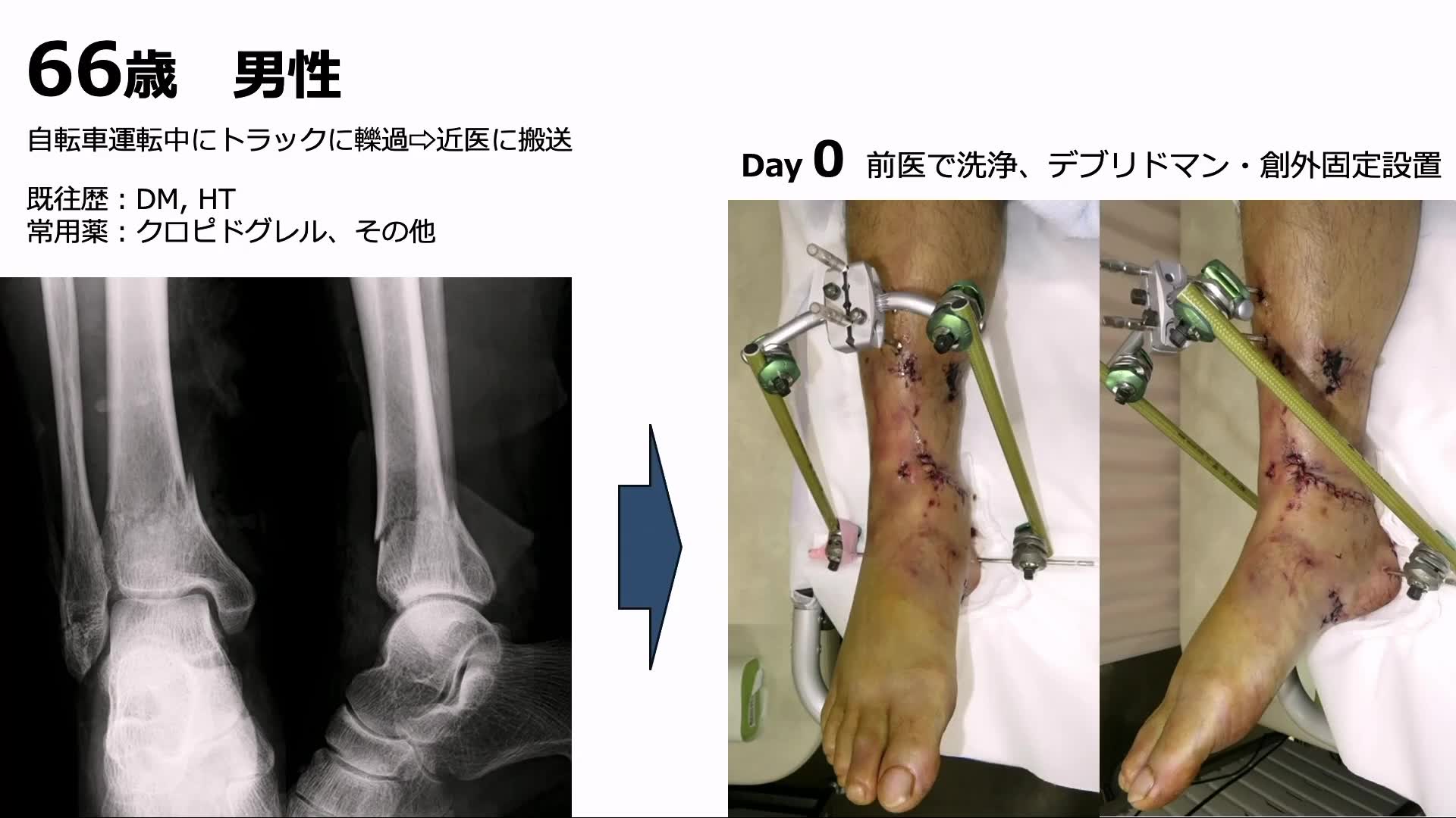 第11回日本重度四肢外傷シンポジウム | e-casebook