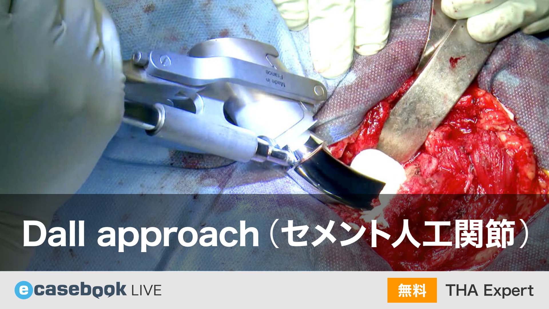 VIDEO: Dall approach（セメント人工関節）[THA] | 整形外科 | e