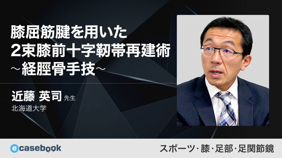 VIDEO: 膝屈筋腱を用いた2束膝前十字靭帯再建術 〜経脛骨手技〜 | 整形