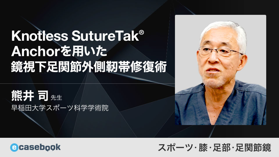VIDEO: Knotless SutureTak® Anchorを用いた鏡視下足関節外側靭帯修復